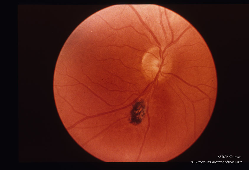 Toxoplasmic retinochoroiditis, healed, 4 years later.