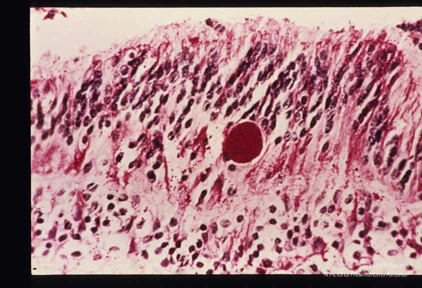 Toxoplasmic retinochoroiditis with cyst in retina. PASH.