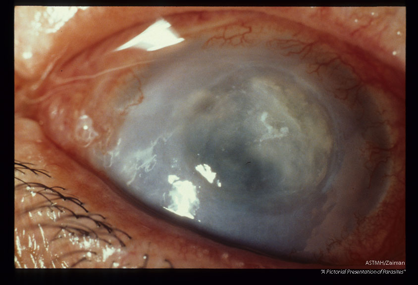 Progressive keratitis in 59 year old male rancher. Slide dated 12-19-73.