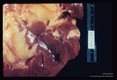 Kidney from above case with incidental tubular adenoma.