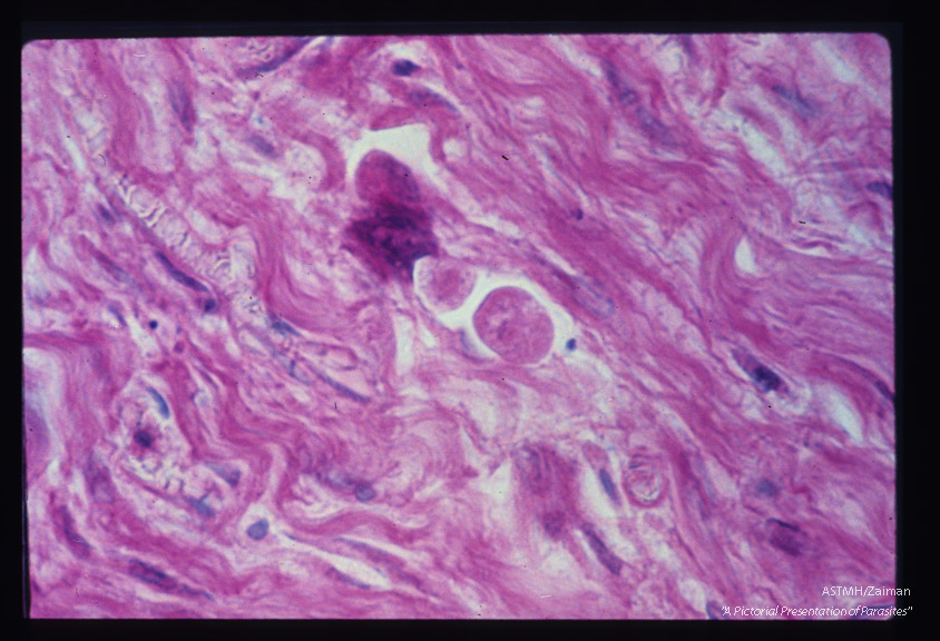 Trophozoite in bronchial wall.