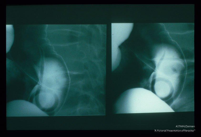Two spot films from an upper gastro-intestinal barium study. White barium in this small bowel outlines an adult worm which displaces the barium and appears dark.