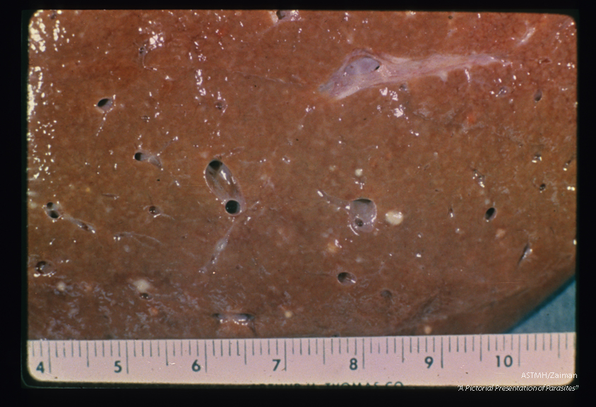 Pseudotubercles in liver. Similar nodules are demonstrated deep in the liver.