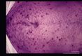 Dermatitis.