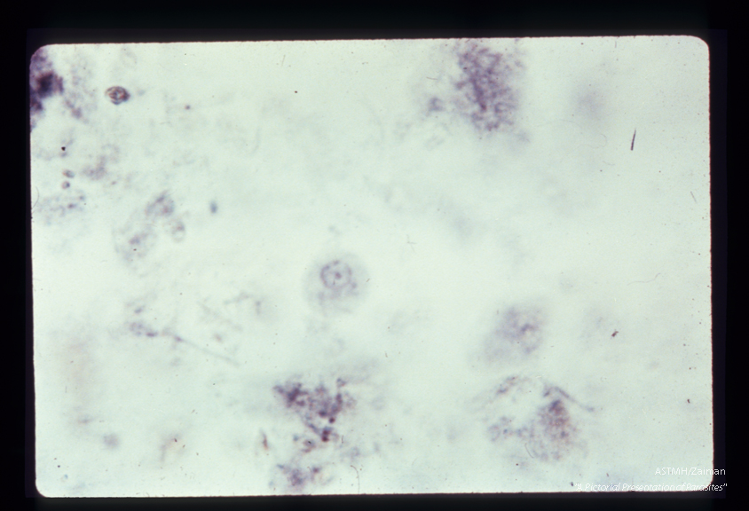 Small race trophozoite, iron hematoxylin stain. The karyosome is small and centrally located; the nuclear chromatin consists of small, fairly regular beads.