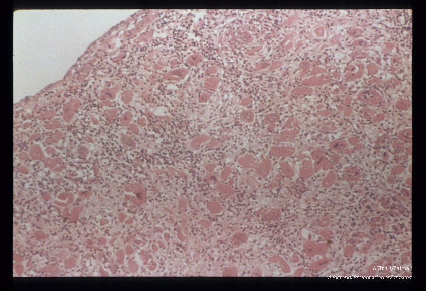 Hematoxylin-eosin stained section of myocardium showing inflammation, fibrosis and masses of leishmania forms.