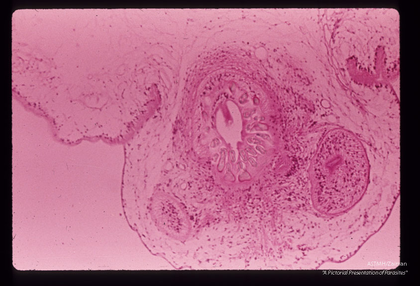 A 32 month old white male in South Dakota suffered progressive lassitude,   anorexia,   irritability,   incoordination and infrequent vomiting.  A suboccipital craniotomy was performed during which a grape-like mass of translucent thin wall cysts was discovered and partially evacuated with difficulty.  Subsequently patient developed flexion rigidity of the  extremities,  non-reactive pupils and decreased consciousness.  A sinus tract at the operative site con­tained more cysts.  The patient died three months after the onset of symptoms.  Section through scolex and membrane.