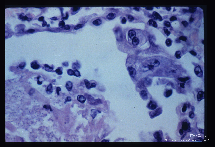 Pneumonia. High power view showing proliferation of cells lining the alveolus and honeycomb material.