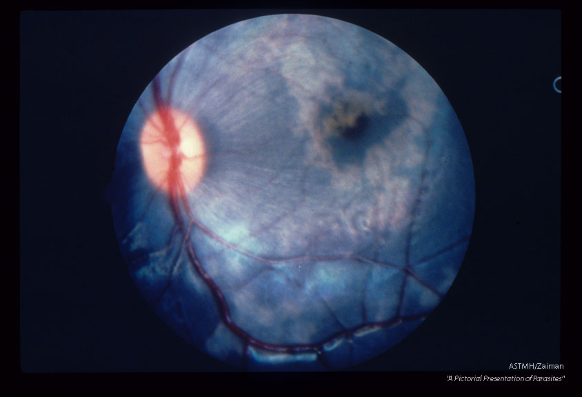 Larva and migratory tracks in fundus of cynomolgus monkey 11 days after experimental infection.