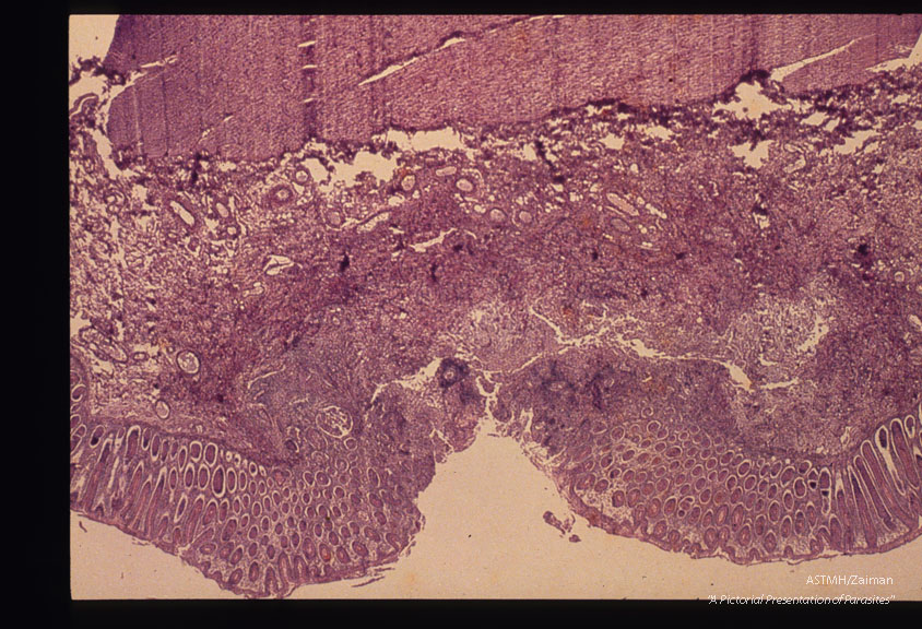 Sections through intestinal ulcers.