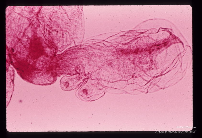 A 32 month old white male in South Dakota suffered progressive lassitude,   anorexia,   irritability,   incoordination and infrequent vomiting.  A suboccipital craniotomy was performed during which a grape-like mass of translucent thin wall cysts was discovered and partially evacuated with difficulty.  Subsequently patient developed flexion rigidity of the  extremities,  non-reactive pupils and decreased consciousness.  A sinus tract at the operative site con­tained more cysts.  The patient died three months after the onset of symptoms.  Cyst wall with two scolices in field.