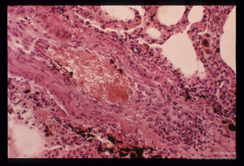 H & E stained section of pulmonary arteriole showing thickening of wall as result of increased pulmonary artery pressures. Same case as slide 24.
