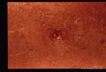 A W.V.U. medical student returning from a summer visit to Costa Rica had this skin lesion.