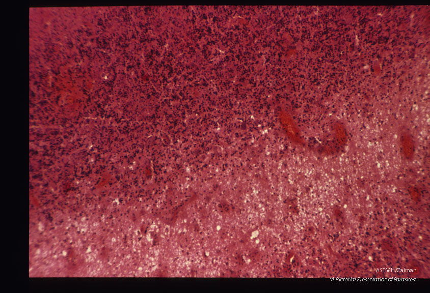 Encephalitis in an East German baby.