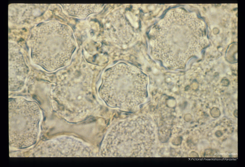 "Star" cysts and a motile amoeba from blood agar plate culture made from human cornea.