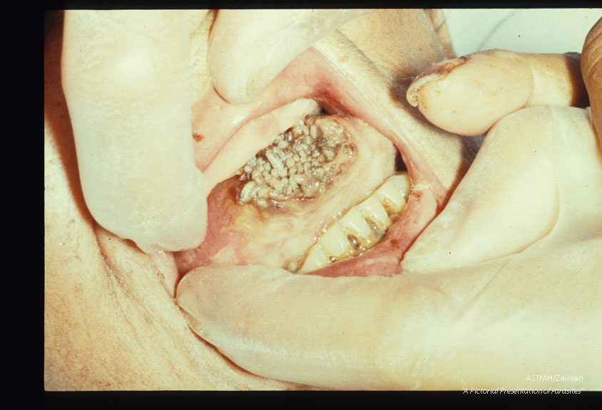 Rare case of myiasis of the tongue.