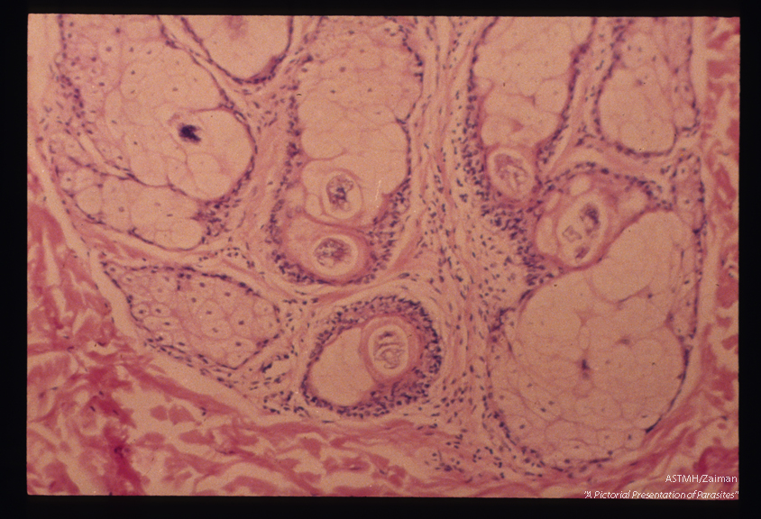 Multiple cross sections of the parasite are seen in this section through the hair follicles of a dog's skin.