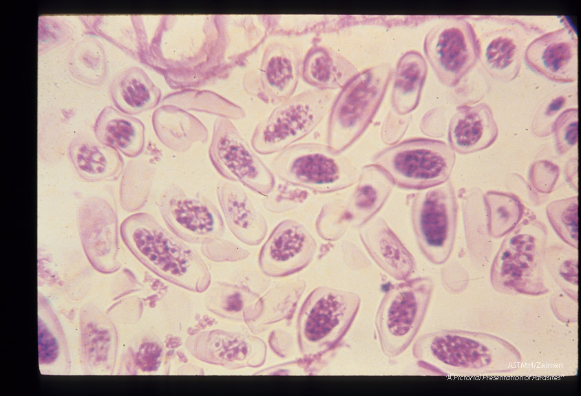 High power view of flattened eggs in uterus of female found in appendix.