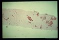 Needle biopsy of human liver.