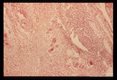 Section of rectum showing eggsand inflammatory infiltrate.