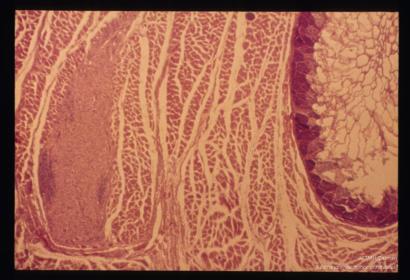 The septal character of the large cysts is better appreciated in this section. The smaller purplish red mass at the upper portion of the slide is a smaller parasite. At the left the section passes through the wall of the parasite.