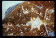 Early pipe stem fibrosis and granulomata in experimentally infected chimpanzee.