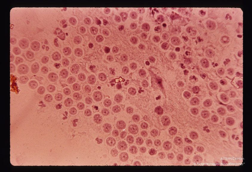 Lee case of primary amoebic meningoencephalitis. Olfactory bulb smear 16 August. Hematoxylin stain.