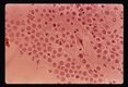 Lee case of primary amoebic meningoencephalitis. Olfactory bulb smear 16 August. Hematoxylin stain.