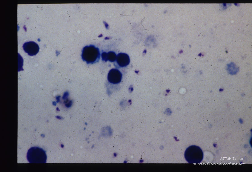 Diffuse cutaneous leishmaniasis. Amastigotes in splenic aspirate.