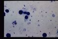 Diffuse cutaneous leishmaniasis. Amastigotes in splenic aspirate.