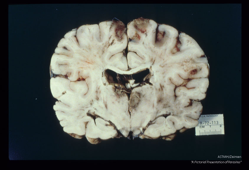 Fatal case with uveitis and meningoencephalitis. Gross pathology.