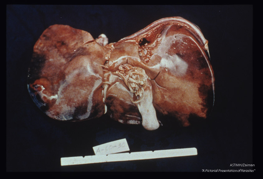 Gross pathology; adults in bile ducts.