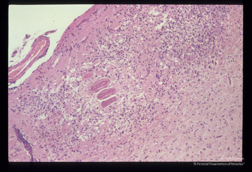 Cerebrum of an experimentally infected hamster showing encephalitis, malacia, necrosis and larva.