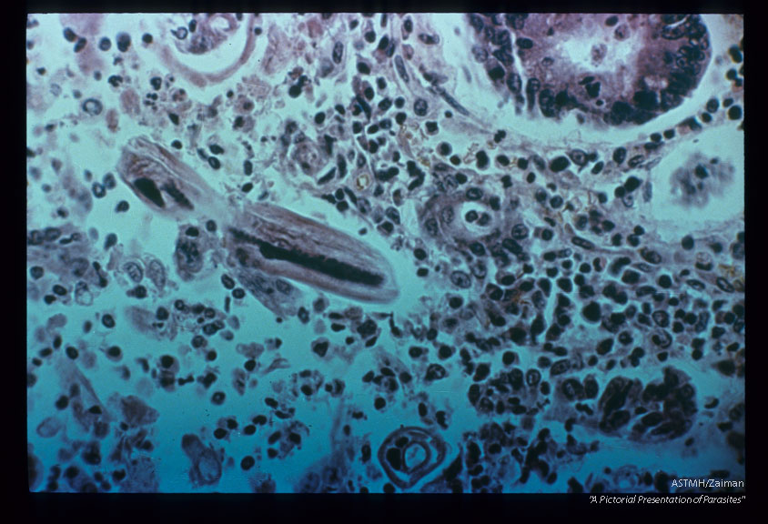 Same case. Portion of adult.