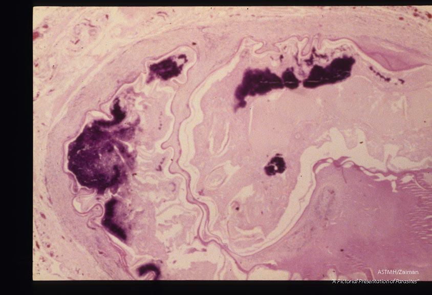 Calcifications associated with degenerating parasite in human mesentery from Ibadan, Nigeria.