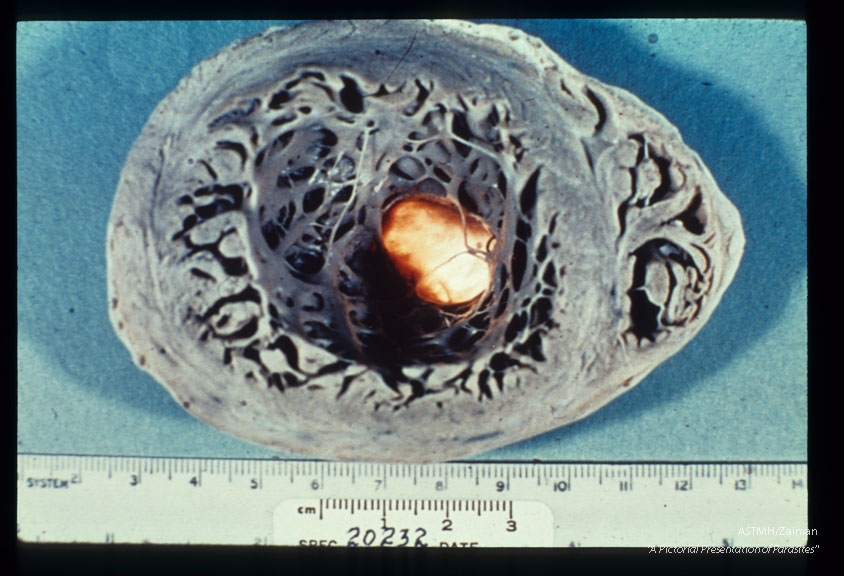 Multiple specimens showing aneurysmal dilatation and thinning of the apical myocardium, plus marked concentric muscular hypertrophy. Light is transmitted through the thinned muscle.