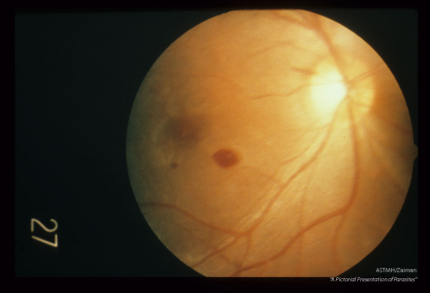 Retinal hemorrhage associated with cerebral malaria.