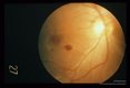 Retinal hemorrhage associated with cerebral malaria.