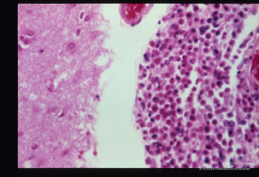 Same case. Eosinophilic meningitis