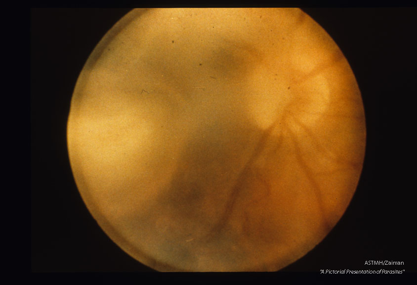 Acute retinal granuloma.