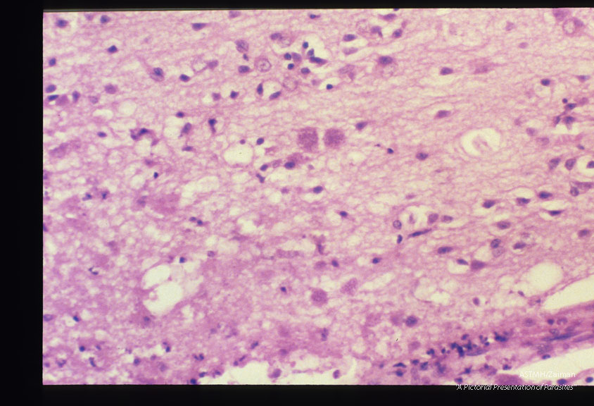 A cardiac recipient received a heart which harbored Toxoplasma and died thereof. Prior to transplantation his serology was negative for Toxoplasma. The parasites are readily visualized in his brain.