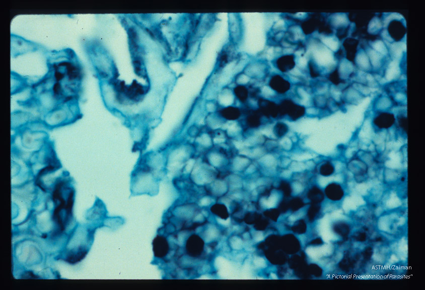 Pneumonia. High powered view of infected lung designed to illustrate dark staining nucleus and parasite wall by silver methenamine technique.