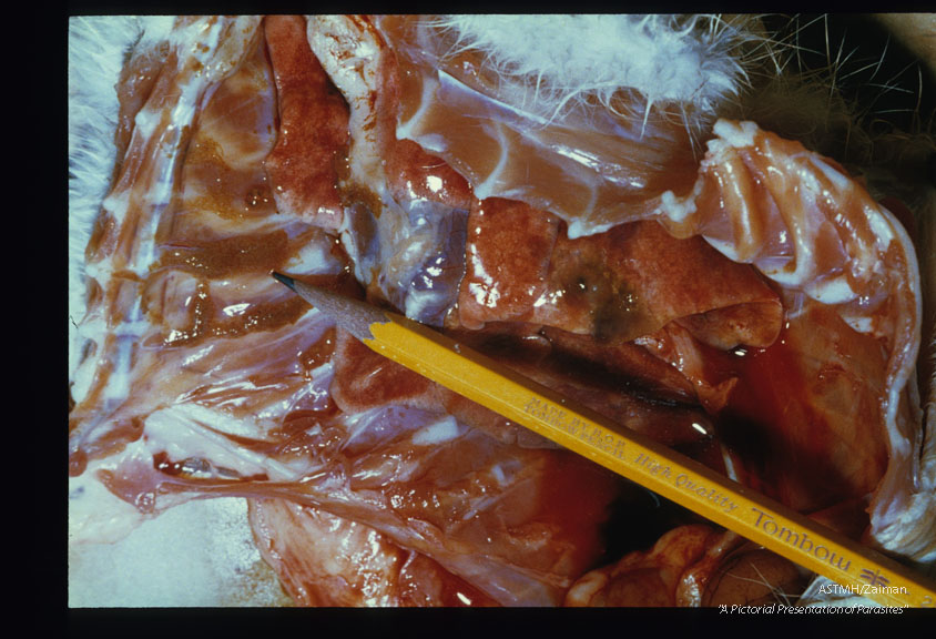 Huge deposits of parasite eggs (pencil tip) are present on the pleura. At the higher magnification, two migrating adult worms are visible.