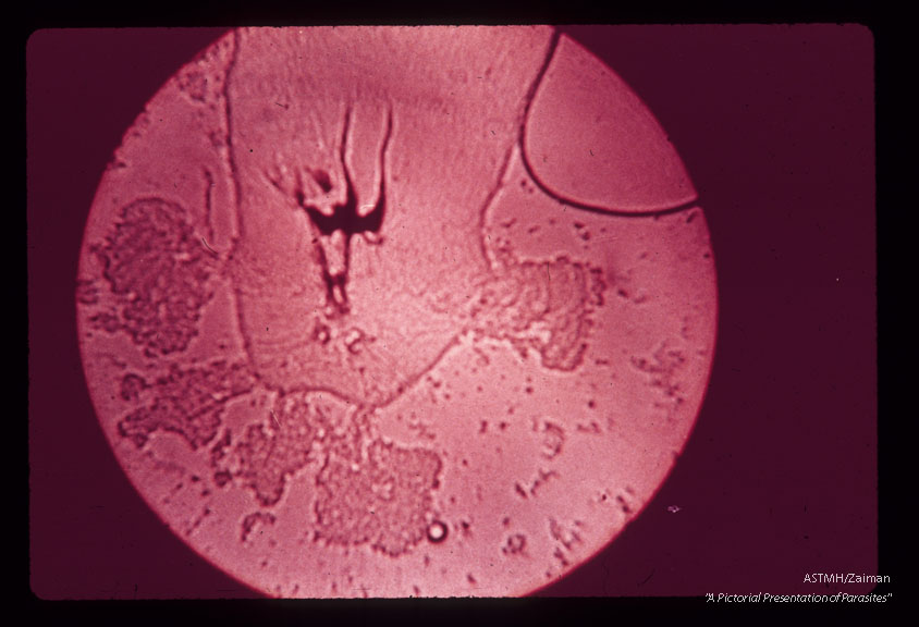 Myiasis. Premature infant died shortly after birth. Numerous first stage larvae were present in the ear. Similar larvae were recovered from the mothers vulva. Efforts to rear maggots were unsuccessful.