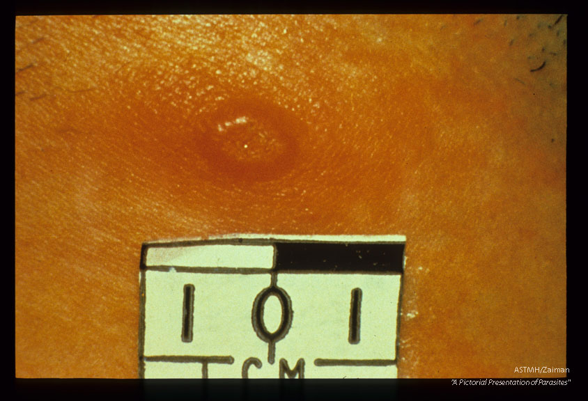 Early lesion at site of bite.