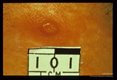 Early lesion at site of bite.