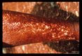 Characteristic leopard skin hyper-and hypopigmentation in the skin of a Liberian male.