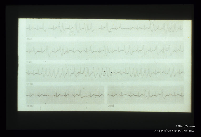 Malignant arrhythmias typical of chronic Chagas’ cardiopathy. Holter tracing.