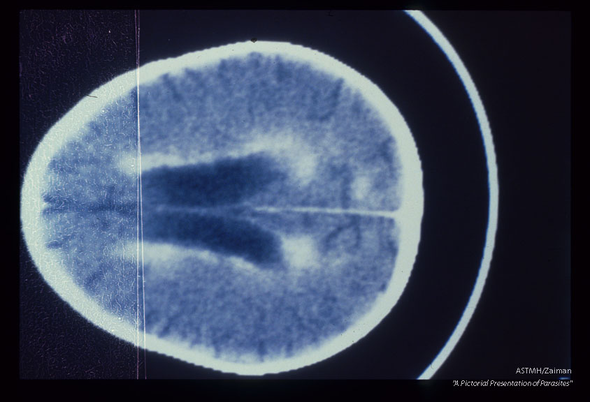 Samecase. Contrast enhanced CT brain scans show ventricular dilatation, periventricular enhance­ment and enlargement of cortical sulci.