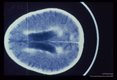 Samecase. Contrast enhanced CT brain scans show ventricular dilatation, periventricular enhance­ment and enlargement of cortical sulci.